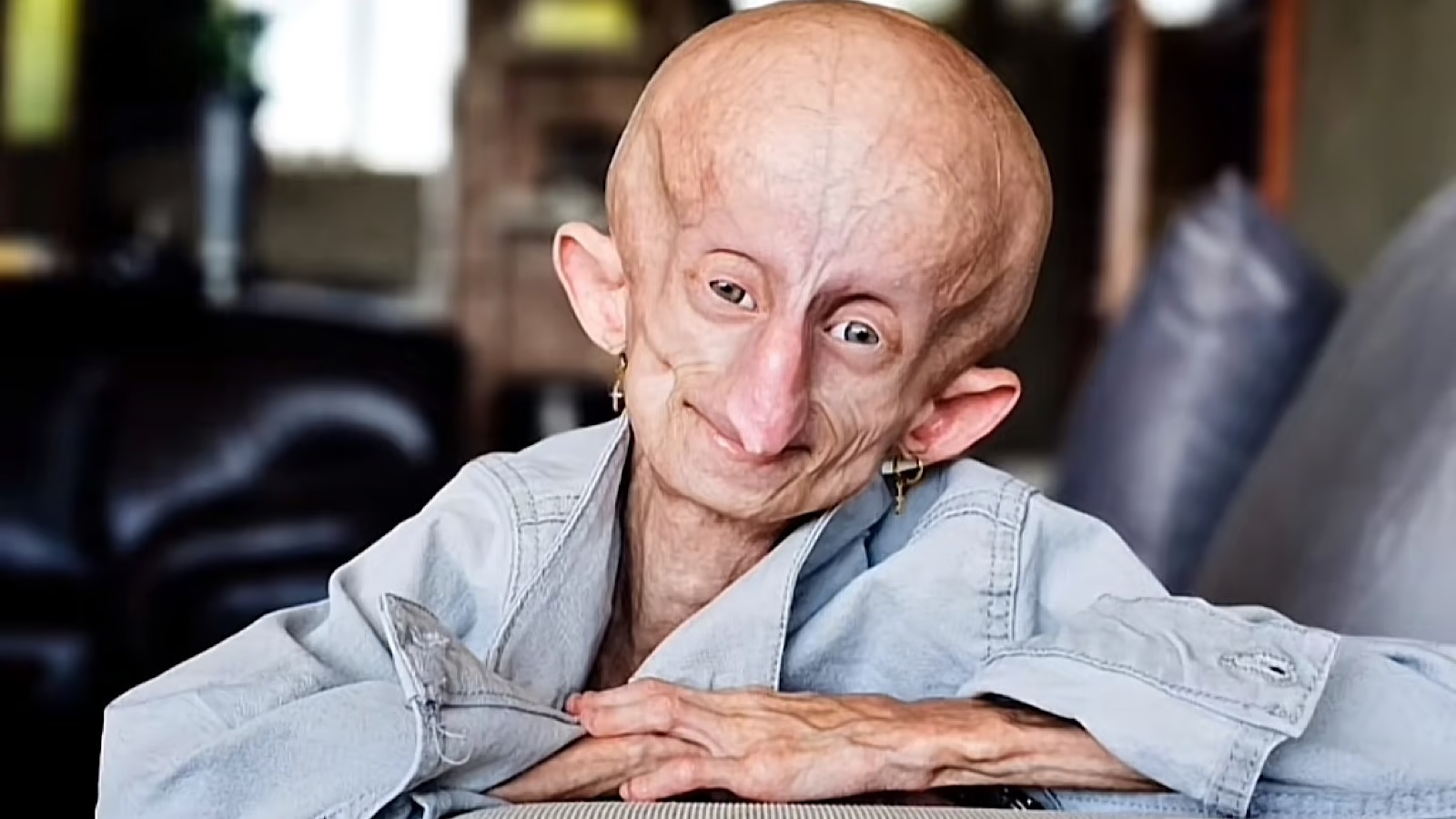 Beandri Booysen: Girl in South Africa with progeria dies