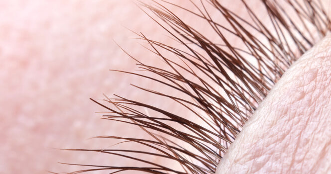 How to spot eyelash mites