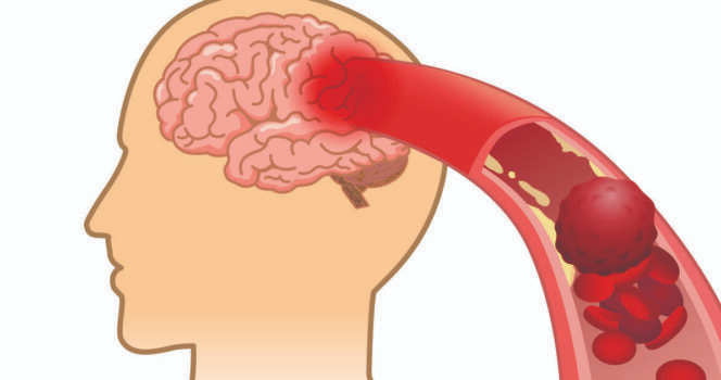 10 signs your arteries might be clogged