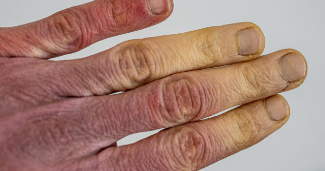 Doctors warn of disease if your fingers and toes change color in cold