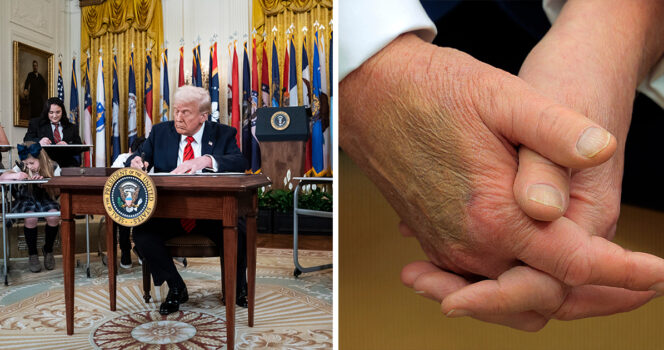 Donald Trump sparks concern after third mysterious bruise spotted on hand